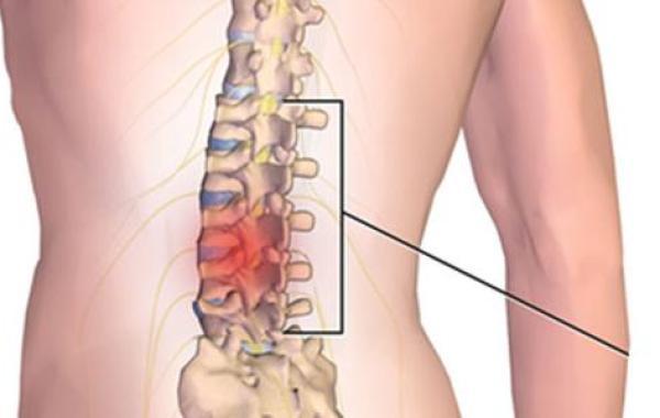 أعراض الانزلاق الغضروفي أسفل الظهر