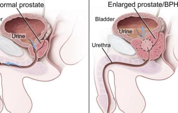 ما هو سبب مرض البروستات