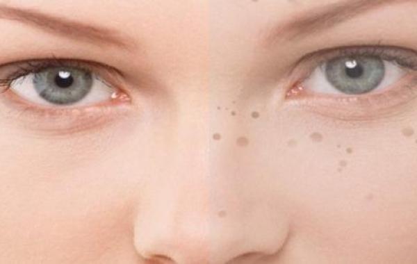 وصفة فعالة لإزالة البقع السوداء من الوجه