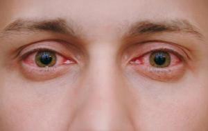 أمراض قزحية العين