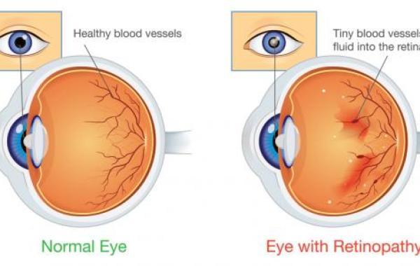 اعتلال شبكية العين