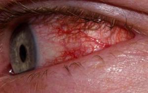 التهاب العين الفيروسي