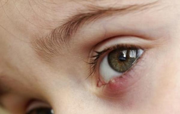 التهاب العين للأطفال