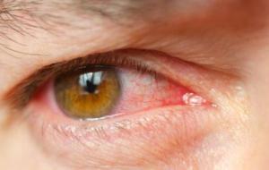 التهاب بياض العين