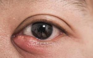التهاب فيروسي في العين