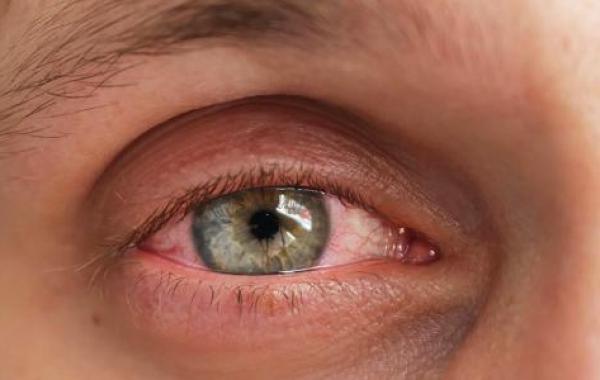 ما هو علاج رمد العين