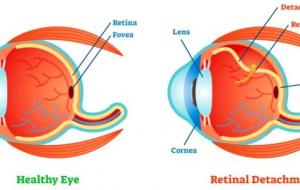 ما هي أمراض شبكية العين