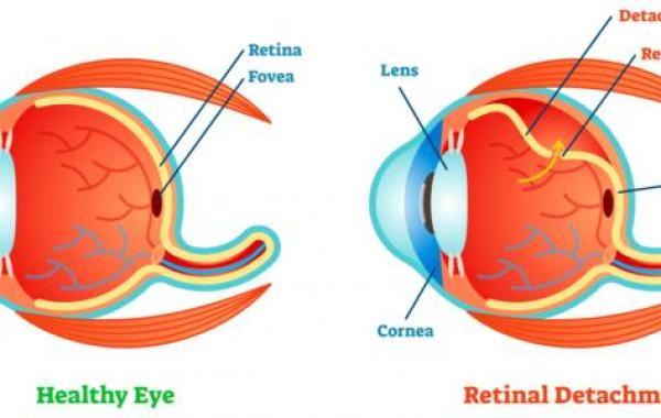 ما هي أمراض شبكية العين
