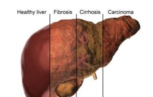الفرق بين تشمع الكبد وتليف الكبد