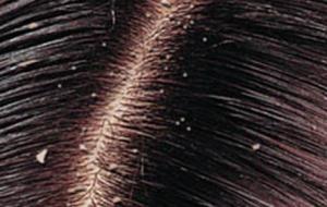 علاج قشرة الشعر الجاف