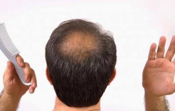 أسباب تساقط الشعر عند الرجال