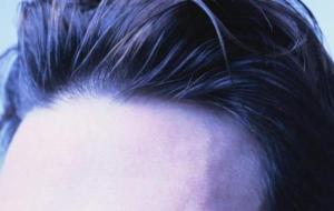 علاج تساقط الشعر من مقدمة الرأس