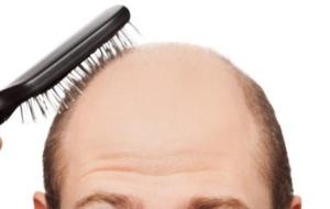 ما هي الأمراض التي تسبب تساقط الشعر