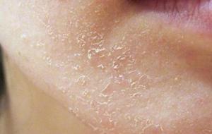 كيفية علاج جفاف الوجه