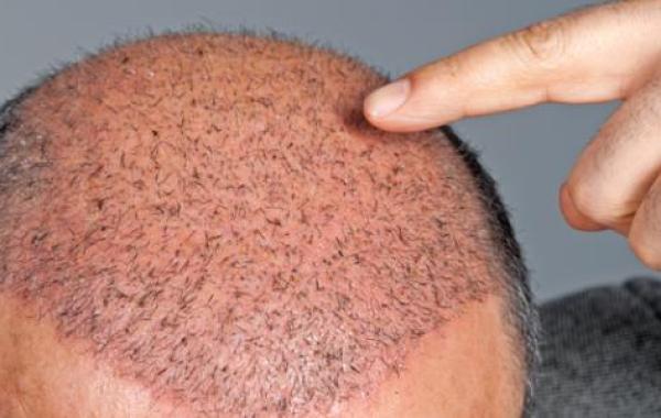 ما حكم زراعة الشعر