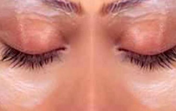 علاج للهالات السوداء حول العينين بطرق طبيعية