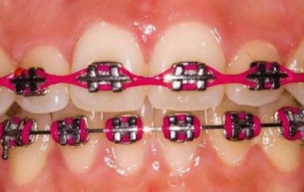 أنواع تقويم الأسنان وأفضلها