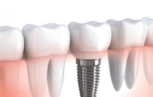 الفرق بين زراعة الأسنان وتركيب الأسنان