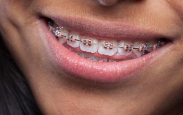 فوائد وأضرار تقويم الأسنان