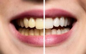 كيفية جعل الأسنان بيضاء