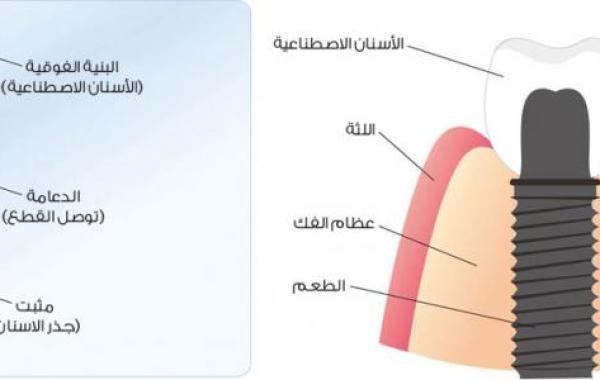 مراحل زراعة الأسنان