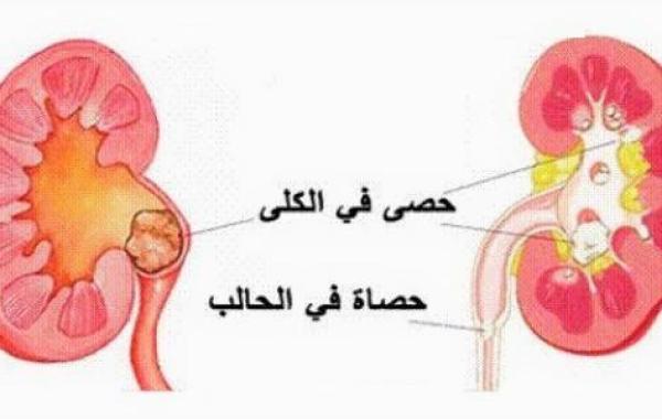 حصى الكلى أسبابها وعلاجها