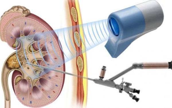 علاج حصوات الكلى