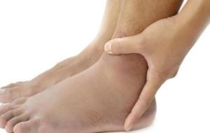 كيفية علاج تورم القدمين