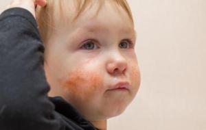 علاج الطفح الجلدي عند الأطفال