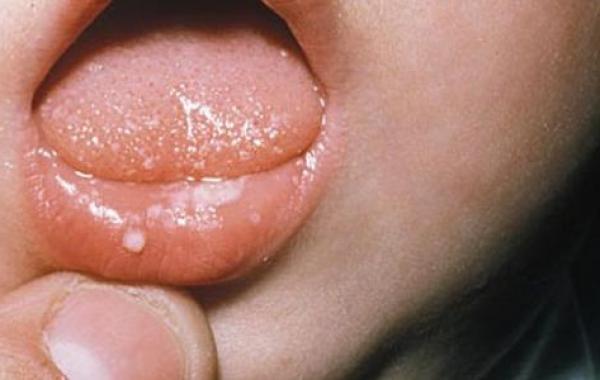 فطريات الفم عند الرضع أسبابها وعلاجها