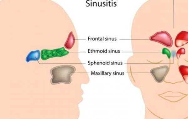 علاج احتقان الجيوب الأنفية