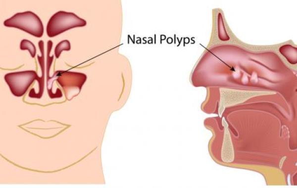 كيفية علاج لحمية الأنف