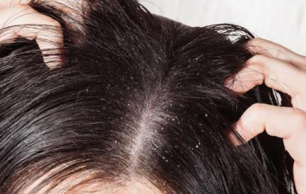 طريقة التخلص من قشرة الشعر