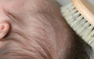 كيفية التخلص من قشرة شعر الرضيع