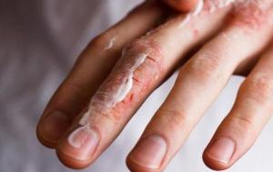 أنواع حساسية الجلد