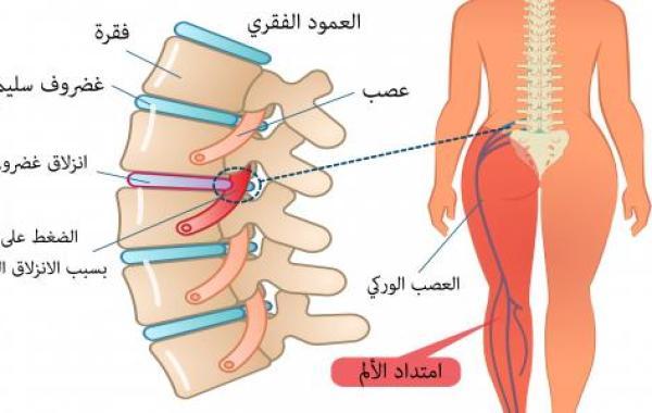 عرق النسا وأعراضه