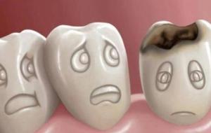 أسباب سقوط الأسنان