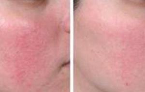 كيفية علاج احمرار الوجه