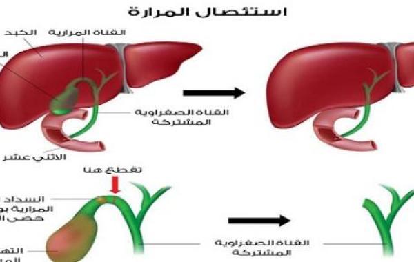 غذاء ما بعد عملية المرارة