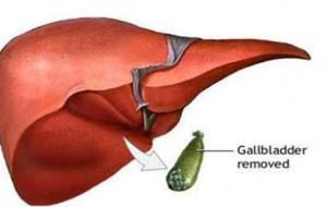 ما هو الغذاء المناسب بعد استئصال المرارة