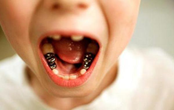 أنواع تآكل الأسنان - فيديو