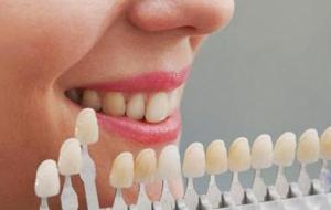 أنواع تبييض الأسنان - فيديو