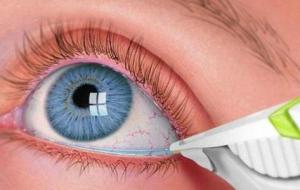 أسباب وعلاج مرض جفاف العين - فيديو