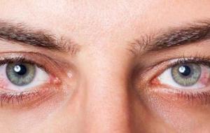 مرض جفاف العين - فيديو