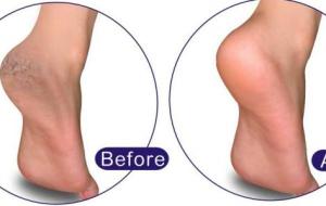 كيفية إزالة الجلد الميت من القدمين