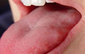 تأثير الزهري على الفم