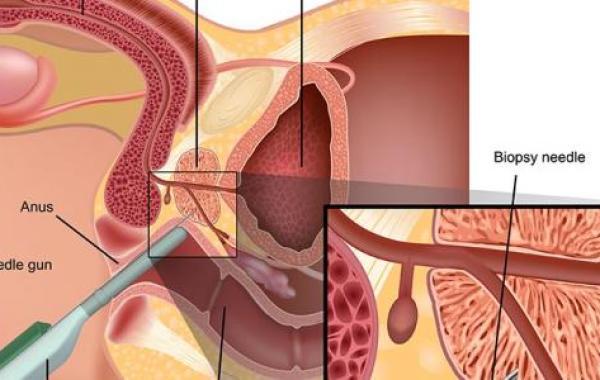 علاج البروستاتا