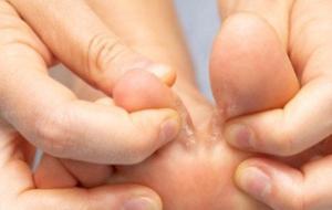 كيف نعالج الفطريات بين أصابع القدم