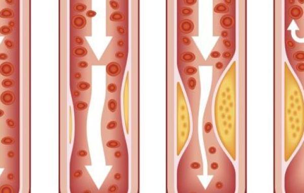 ما هو مرض تصلب الشرايين