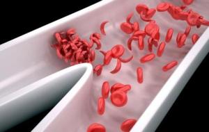 مرض فقر الدم المنجلي